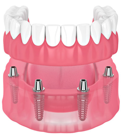 Livre-se da Dentadura